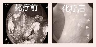 直肠癌已确诊，医生却说不要急着做手术？我需要一个合理解释！