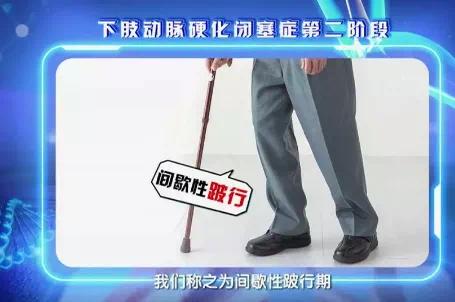 下肢动脉硬化闭塞已经烂腿怎么治,下肢动脉硬化闭塞症就是老寒腿吗