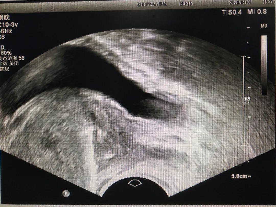 超声介入胆管引流,超声引导下胆道置管引流