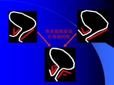 笑尿了也是一种病听听专家怎么说,笑尿了具体是什么病