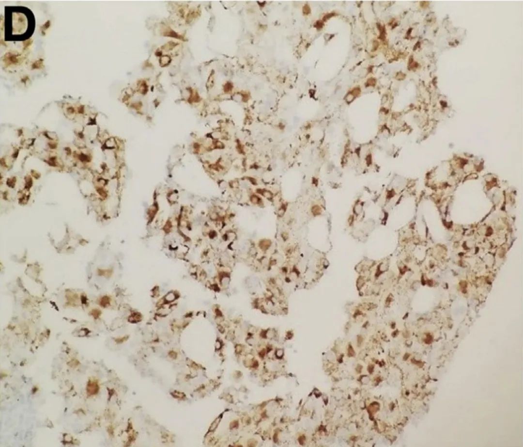 肝脏方面的病例,肝脏罕见病