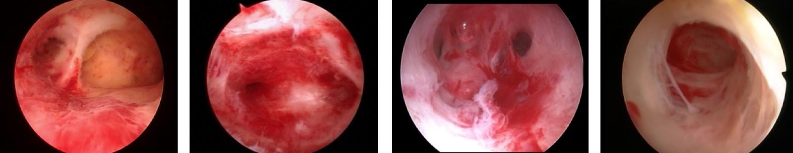 怀孕时宫腔粘连怎么办,宫腔粘连怀孕出血流产