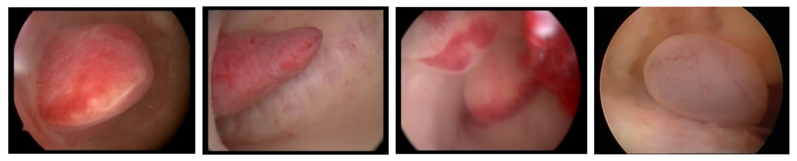 内膜息肉切除后多久怀孕最佳,宫腔内膜中有小息肉会影响怀孕吗