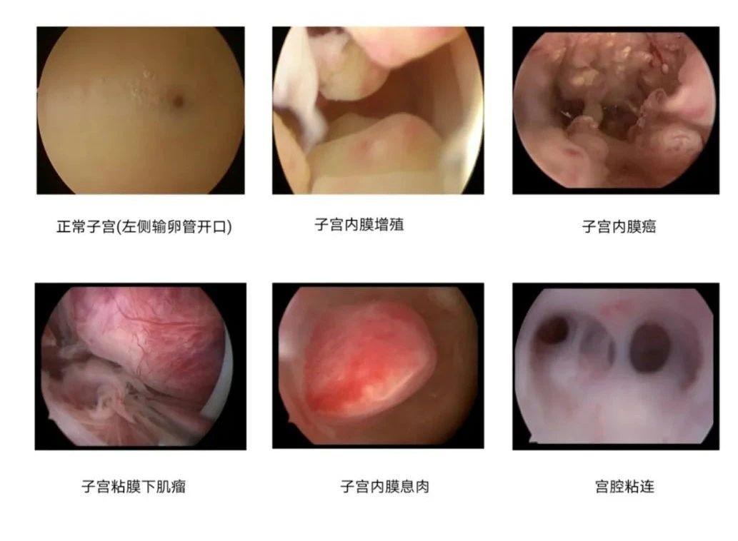 取完卵需要做宫腔镜检查么,宫腔出血需要做宫腔镜检查吗