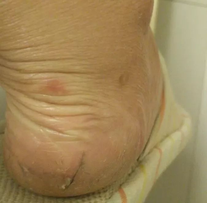 你穿高跟鞋经历过磨脚的痛苦吗,穿高跟鞋脚掌死皮怎么去除