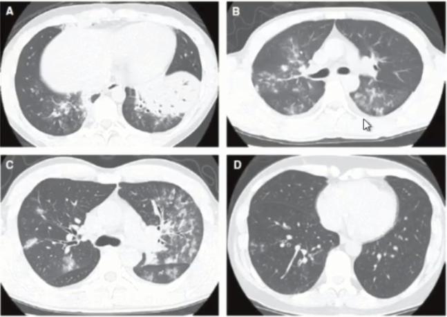 支原体肺炎症状应该注意什么,支原体肺炎这些症状要警惕