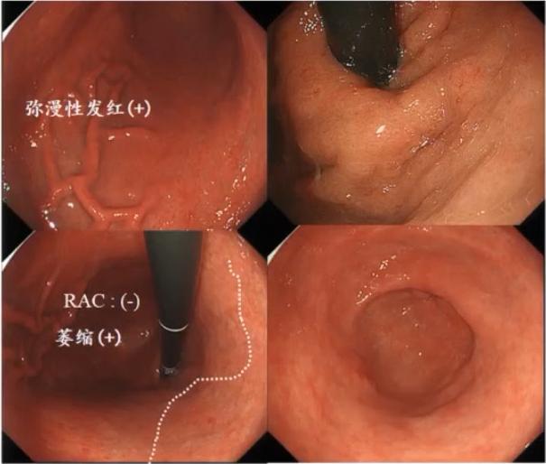 CGC2020|吕宾教授：Hp根除对胃黏膜的影响（附内镜下图像）
