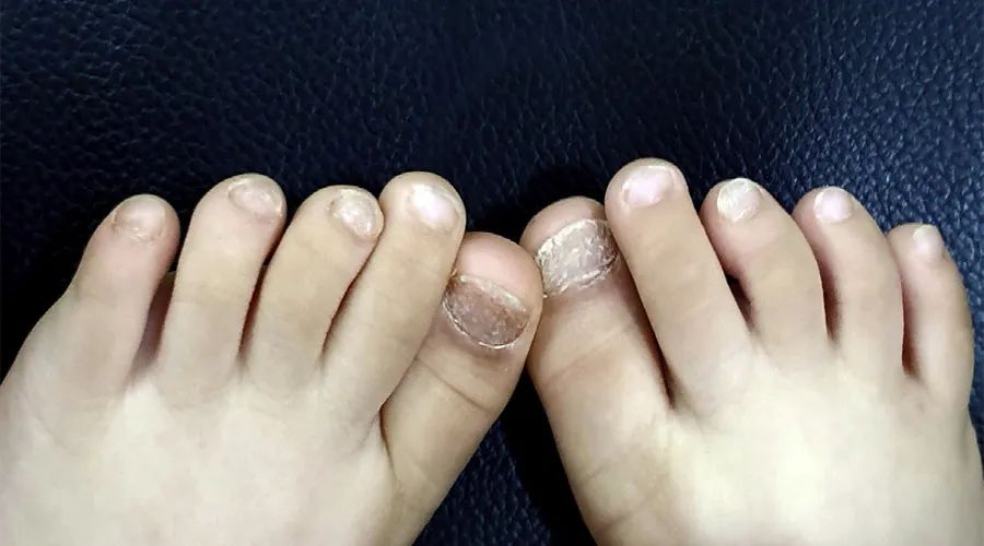 甲萎缩是甲癣吗,甲分离症和甲癣区别