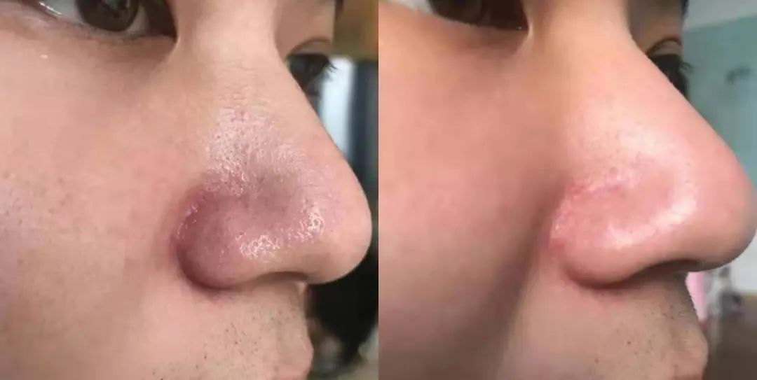 痘痘挤出黄水还是血水,痘痘挤出来的白色乳浆是什么