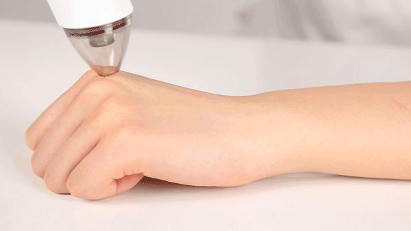 痘痘挤出的白米粒是什么,痘痘挤出来的白色乳浆是什么