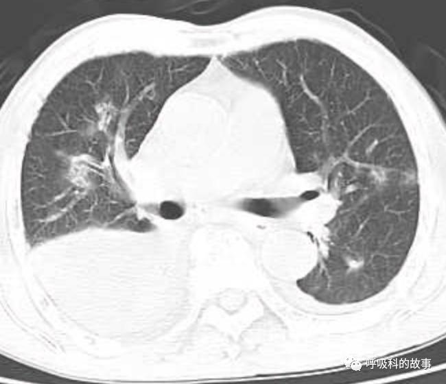肺炎的最佳治疗方法及药物,肺炎的治疗方法和流程