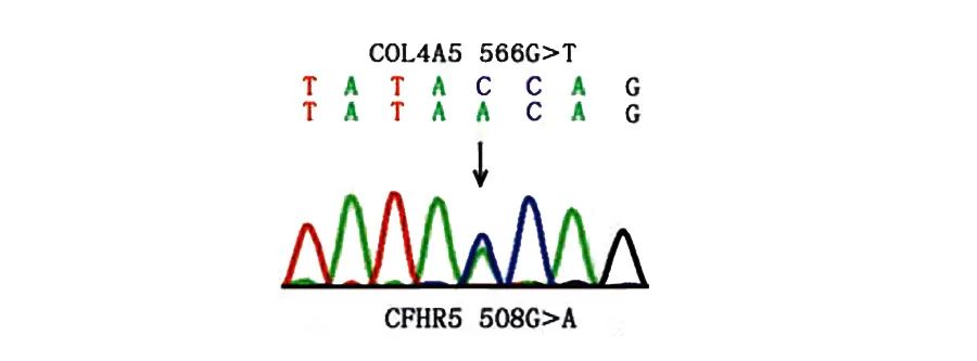 薄基底膜肾病和iga肾病区别,膜性肾病IgA肾病