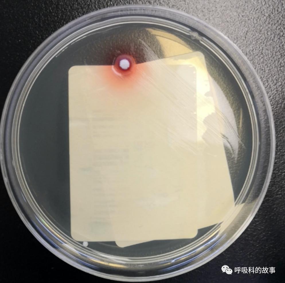 我是如何诊治肺炎的？（4）——如何理解抓住关键信息（2）