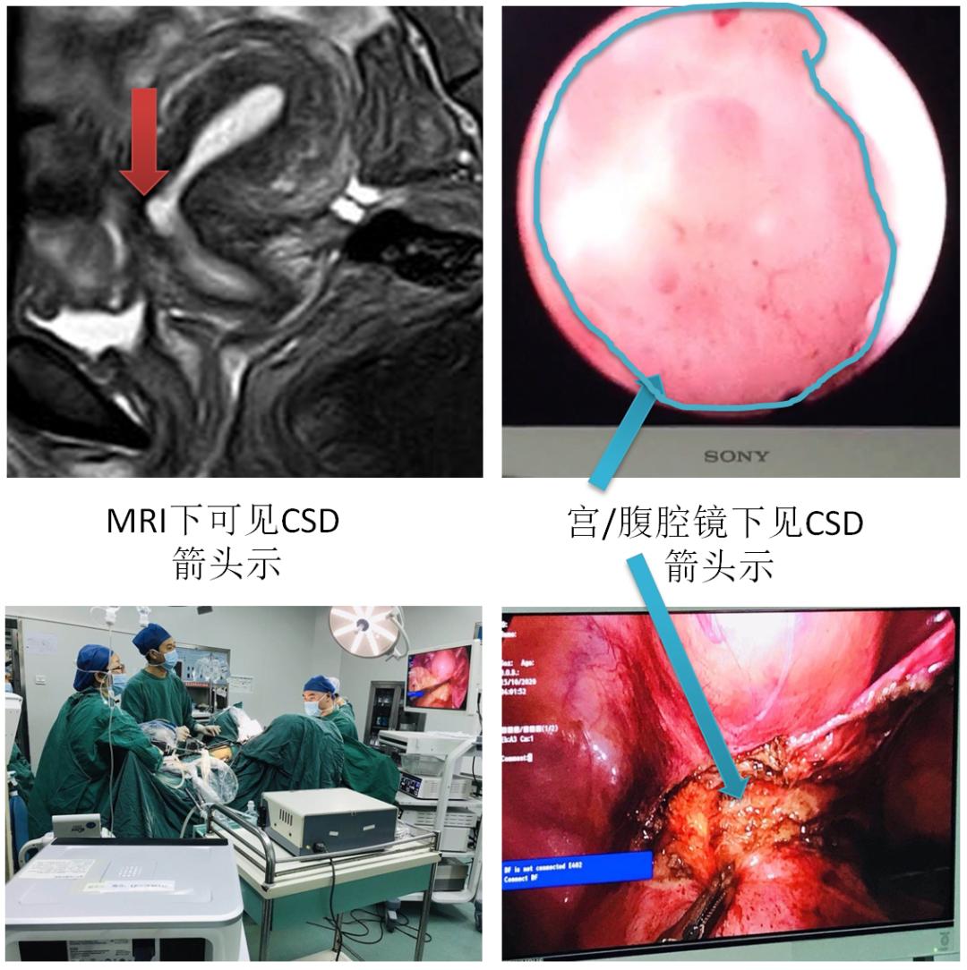 剖宫产术后有多少人有憩室,剖宫产后再次妊娠顺产大出血概率