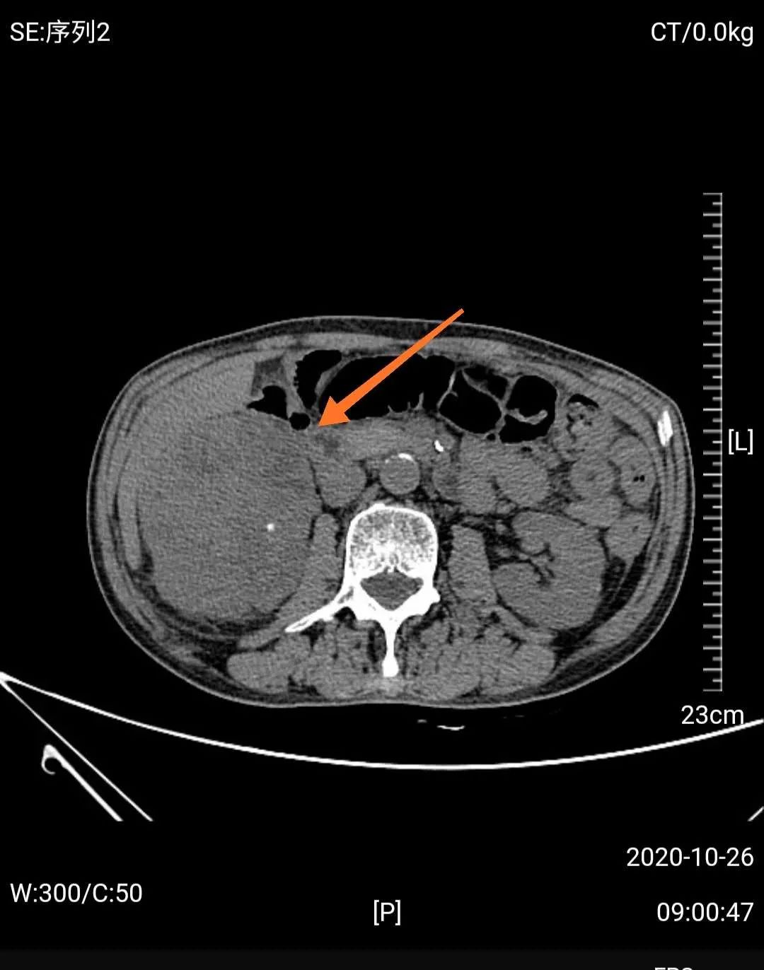【警惕】耄耋老人患巨大肾癌，佛中医泌外团队3D腹腔镜微创治愈