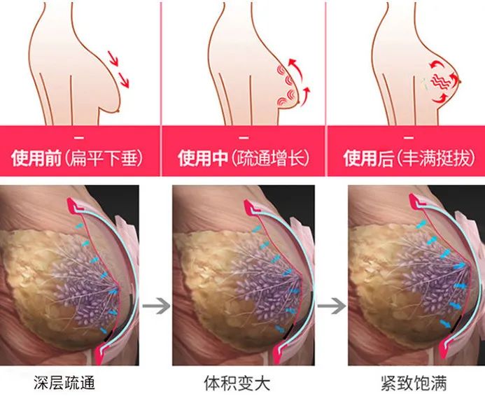 如何快速丰胸且不会反弹,不吃药怎么丰胸