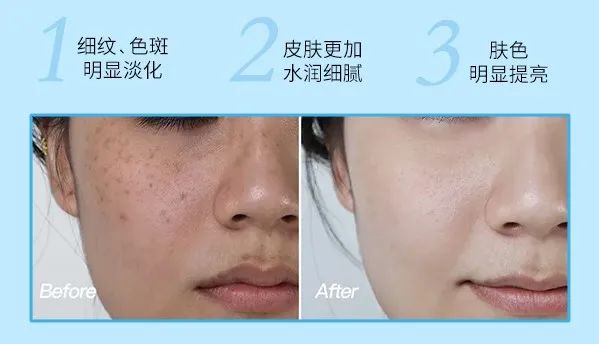 花了3万做激光，才彻底懂了：医生为什么劝你别去斑