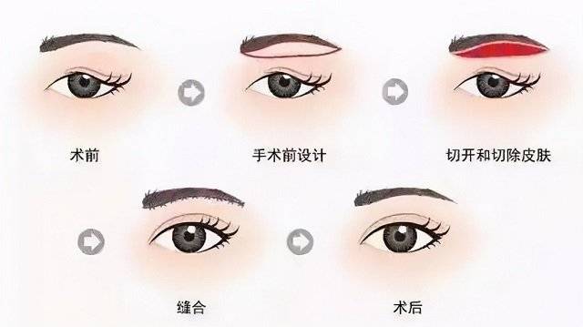 无痕切眉会留下疤痕吗,切眉术疤痕修复