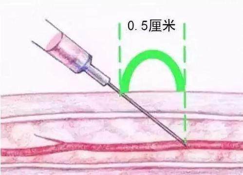 献血怎么按压针眼,献血后针眼附近青紫怎么办