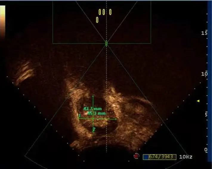 凶险的胎盘植入，轻松解决！市妇保院海扶专科成功治愈多位胎盘植入患者