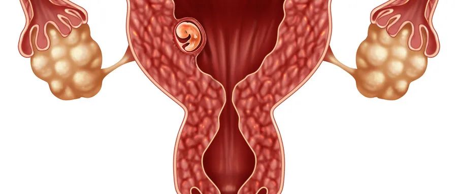 珠江妇幼子宫疤痕憩室,子宫疤痕憩室怎么改善经期长