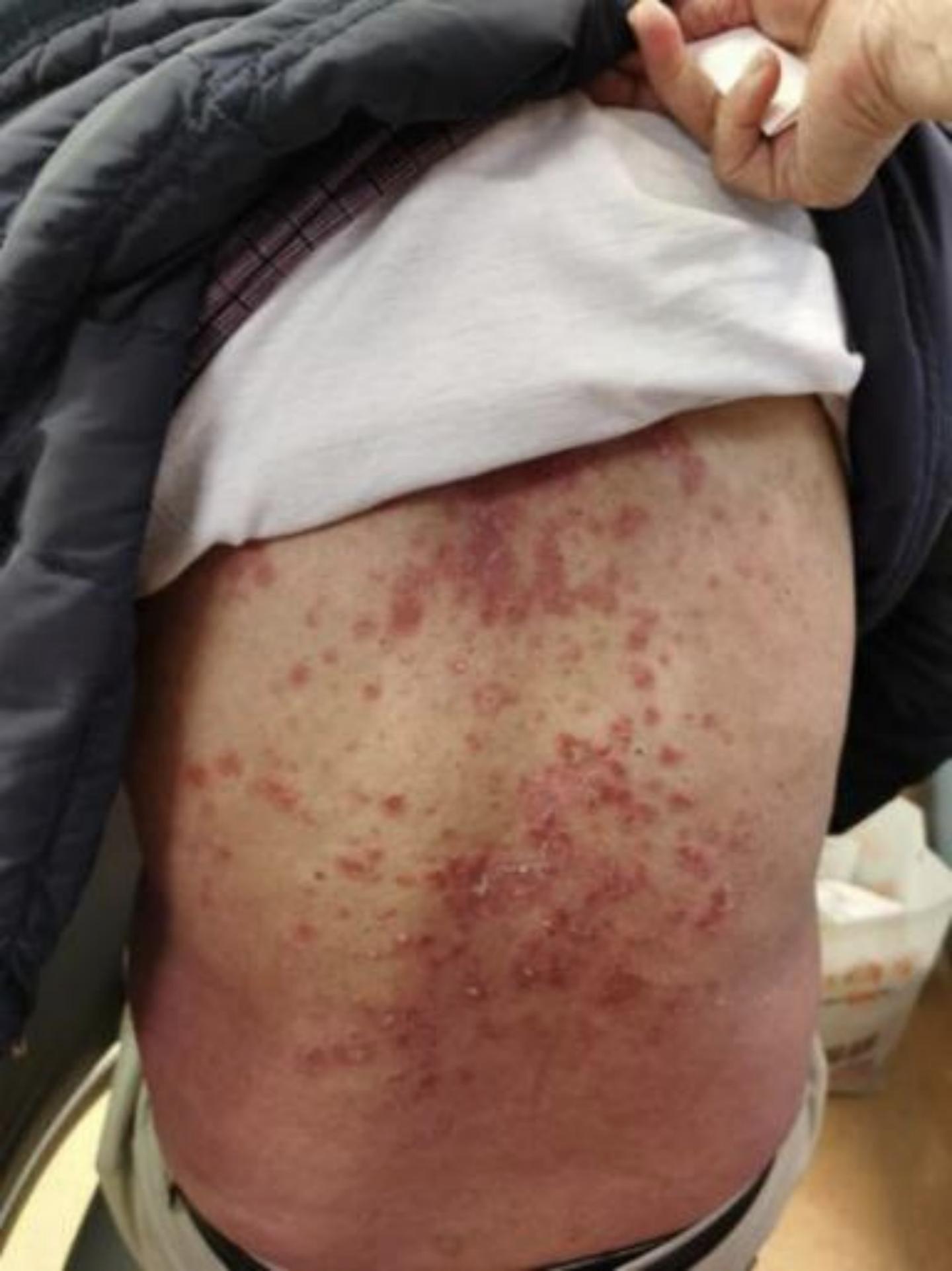 七旬香港阿叔受银屑病困扰10年，在中山七院获得有效救治