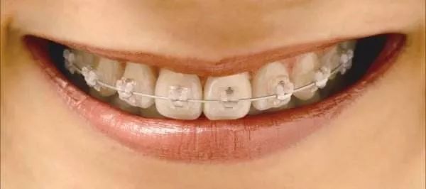 陶瓷还能用来做矫正?怎么做到的?