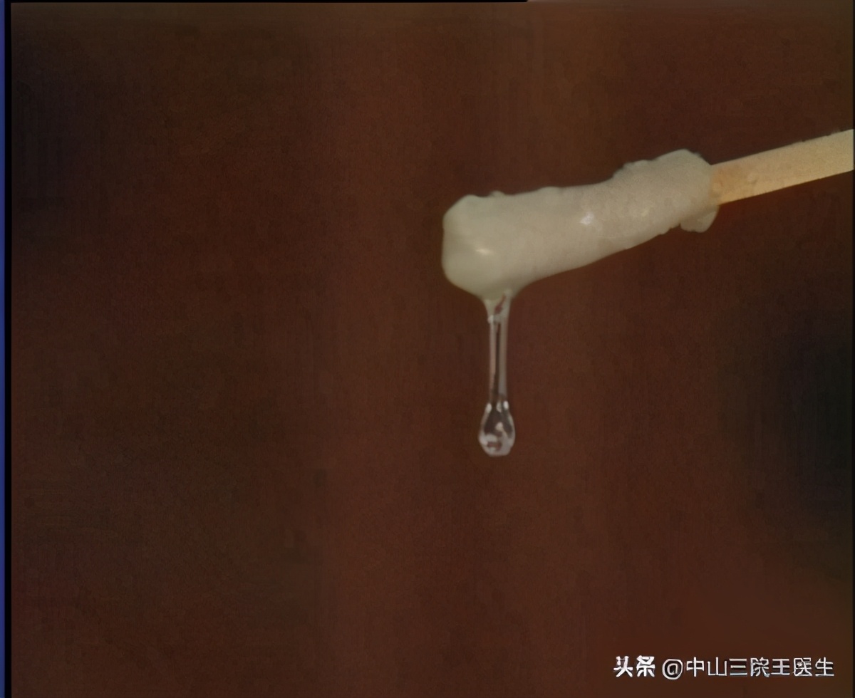 白带健康的晴雨表是什么意思,白带的晴雨表