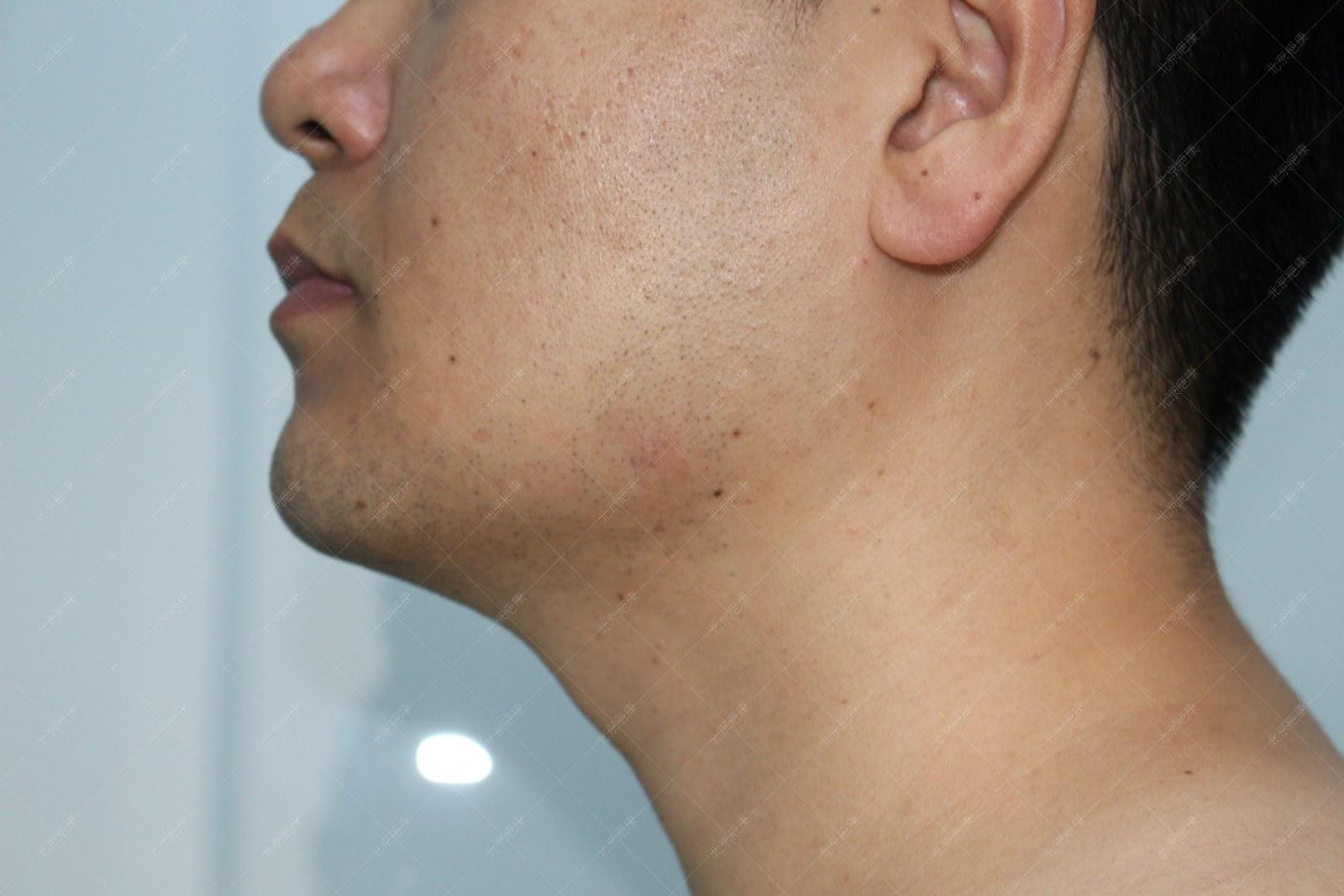 疤康疤痕疙瘩治疗效果怎么样,疤康治疗效果是真实的吗