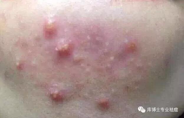 看懂各种痘痘类型和应对方法,一分钟教你分辨痘痘类型