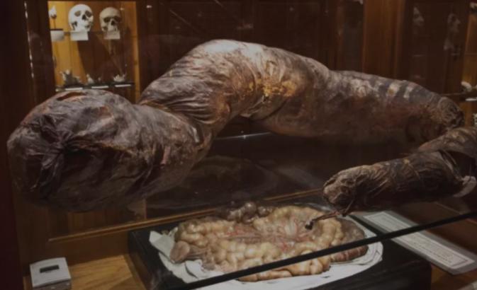 英国男子47天不排便,英国男子便秘常年不上厕所