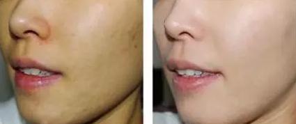 牙科半导体激光美白效果怎么样,激光美白牙齿和冷光美白哪个好