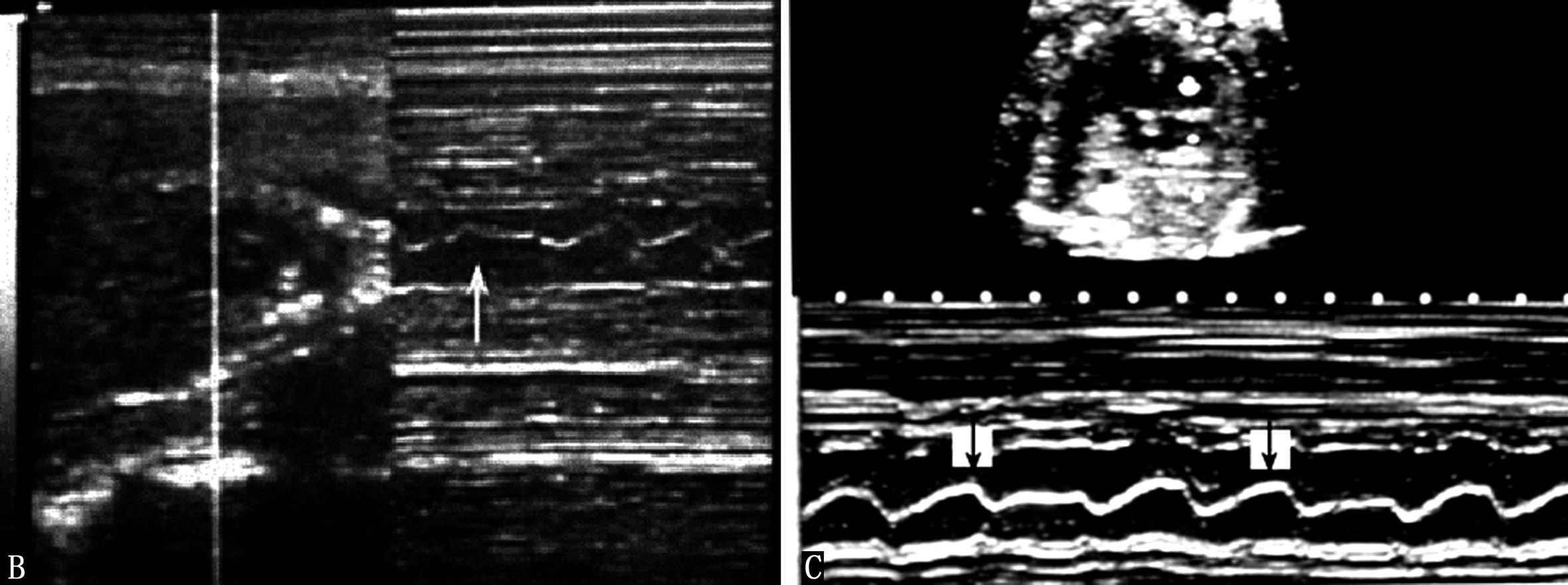 做胎儿心动图胎心165次每分,做彩超胎儿动来动去