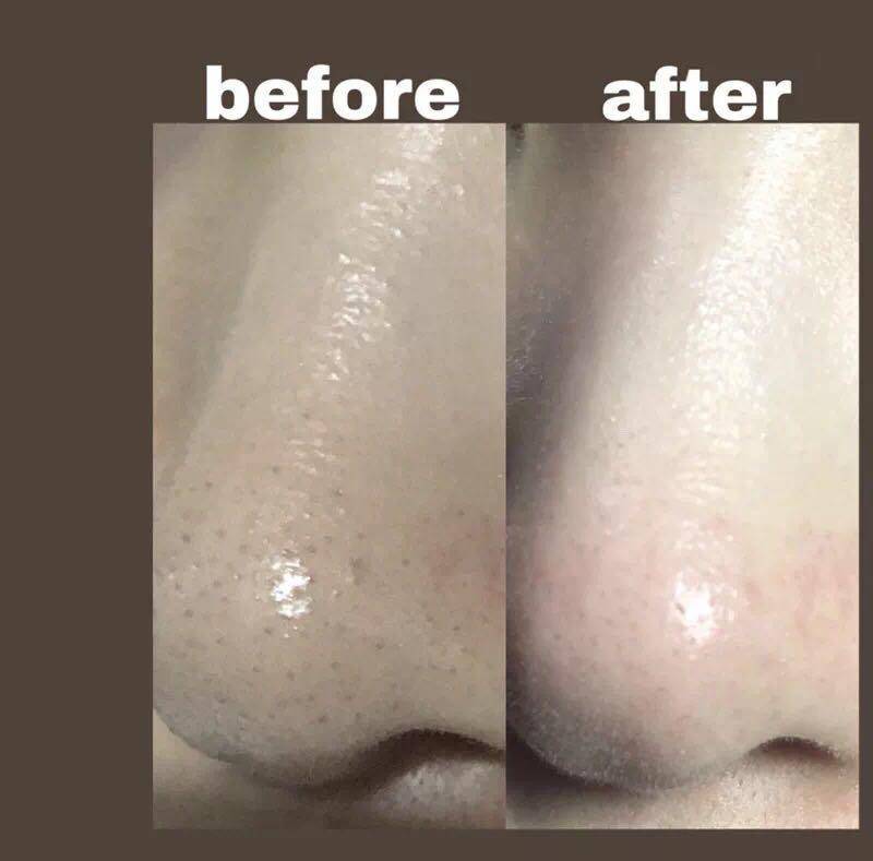 去黑头粉刺比较有效的方法,去黑头粉刺的最简单方法