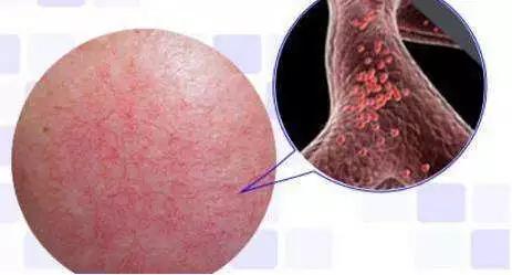 七种方法教你摆脱红血丝,红血丝的正确调理方法