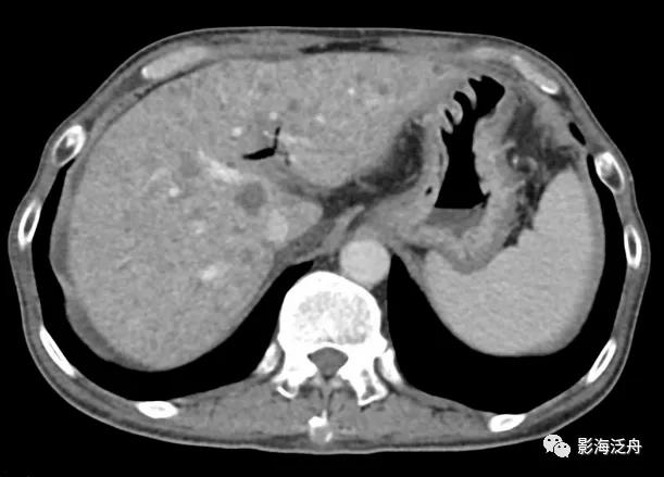 肝脏弥漫性病变严重吗,肝脏弥漫性的病变的症状