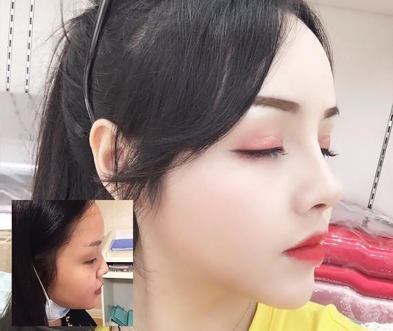 隆鼻多大年龄能做,隆鼻有年龄限制