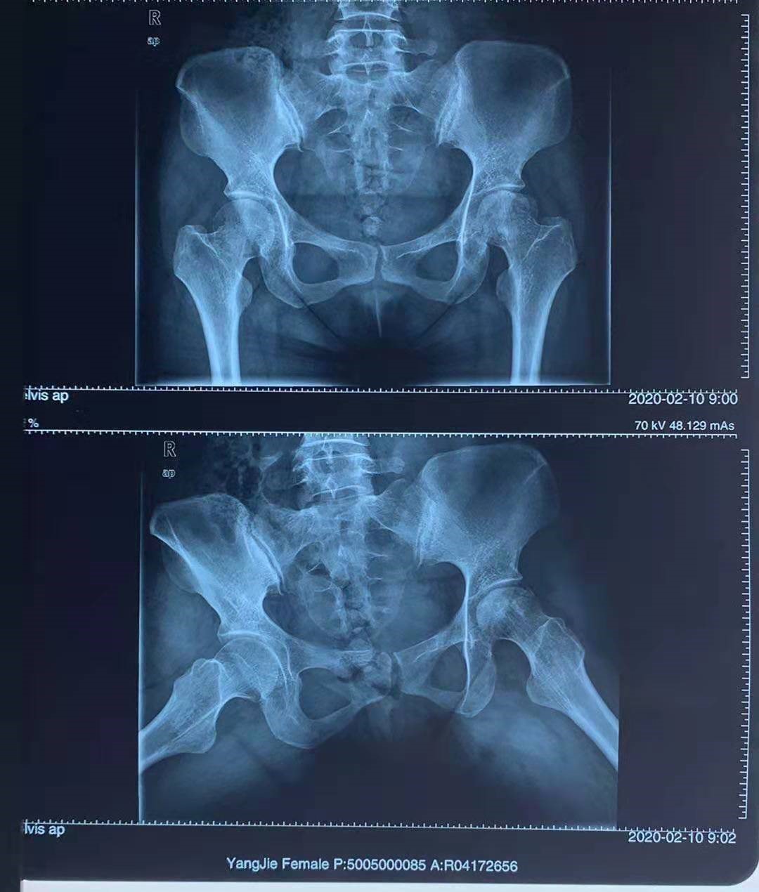 股骨头坏死分期分型图片,股骨头坏死的概念及临床分期特点