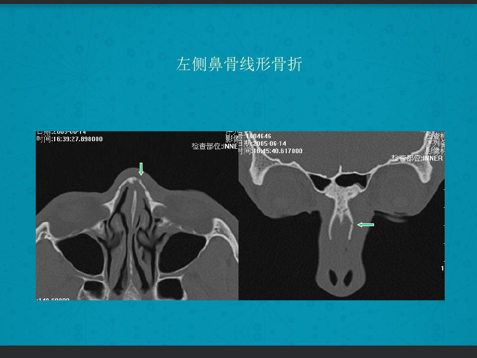 鼻骨骨折复位全过程,诊断证明鼻骨骨折问号是什么意思