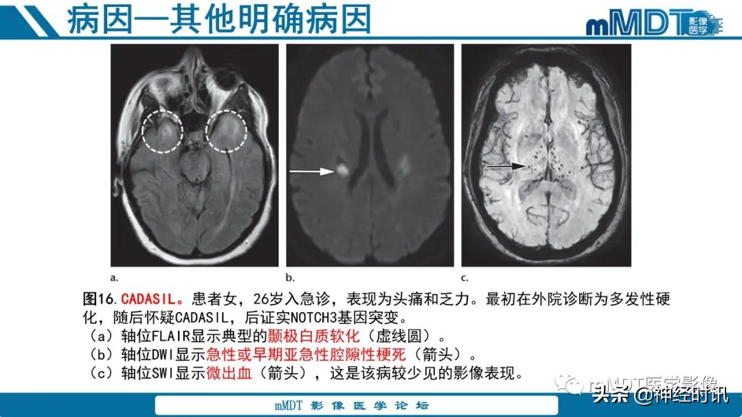 急性缺血性脑卒中ppt素材图片,青年缺血性脑卒中ppt