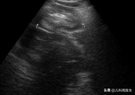 宝宝肠绞痛会哭一整天吗,新生儿怎么区分肠绞痛还是肠套叠
