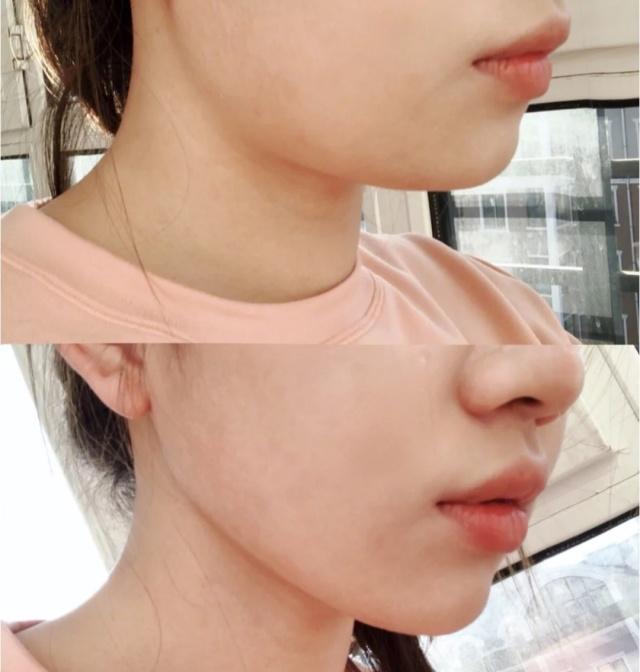 如何消除双下巴让脸型更好看,下巴松弛造成的双下巴面相