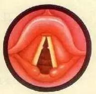 一招改掉用喉咙唱歌的习惯,怎样用气息唱歌打开喉咙