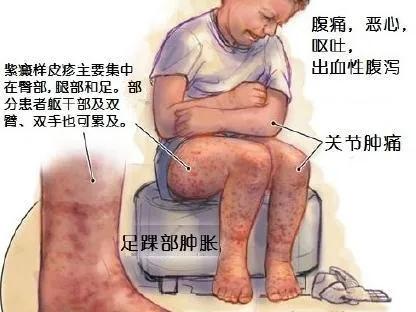 被臭蚊子叮咬起红包怎么治疗,被蚊子叮咬起了很大的红包