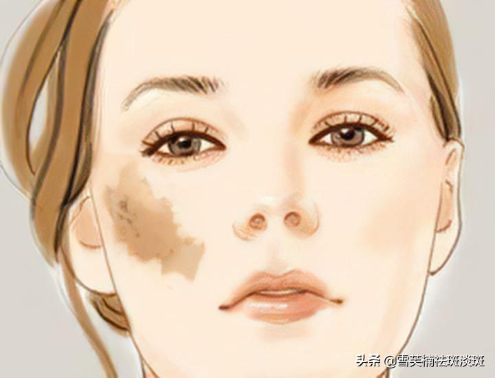 去斑点的最好方法淡斑精华,去斑点的最好方法淡斑