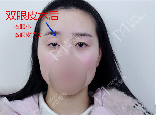 女子双眼皮术后大小眼,大小眼做了双眼皮感觉眼角不对称