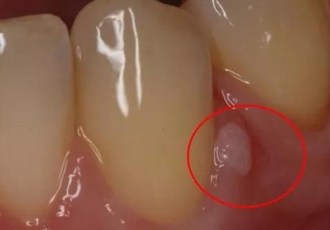 牙龈长脓包挤破又长回来,牙龈长脓包弄破了第二天又有脓