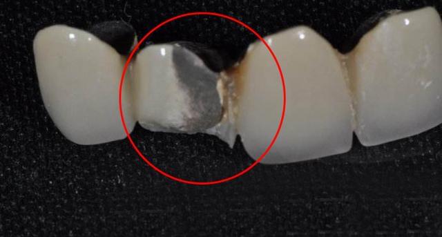 牙齿清理视频解压,烤瓷牙崩瓷了