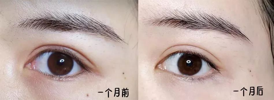 玻尿酸蒸汽热敷眼罩有用吗,热敷眼罩可以加速玻尿酸代谢吗