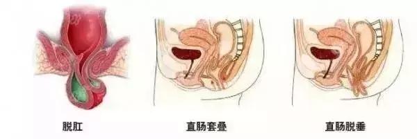 肛门里有“一坨肉”脱出来了。